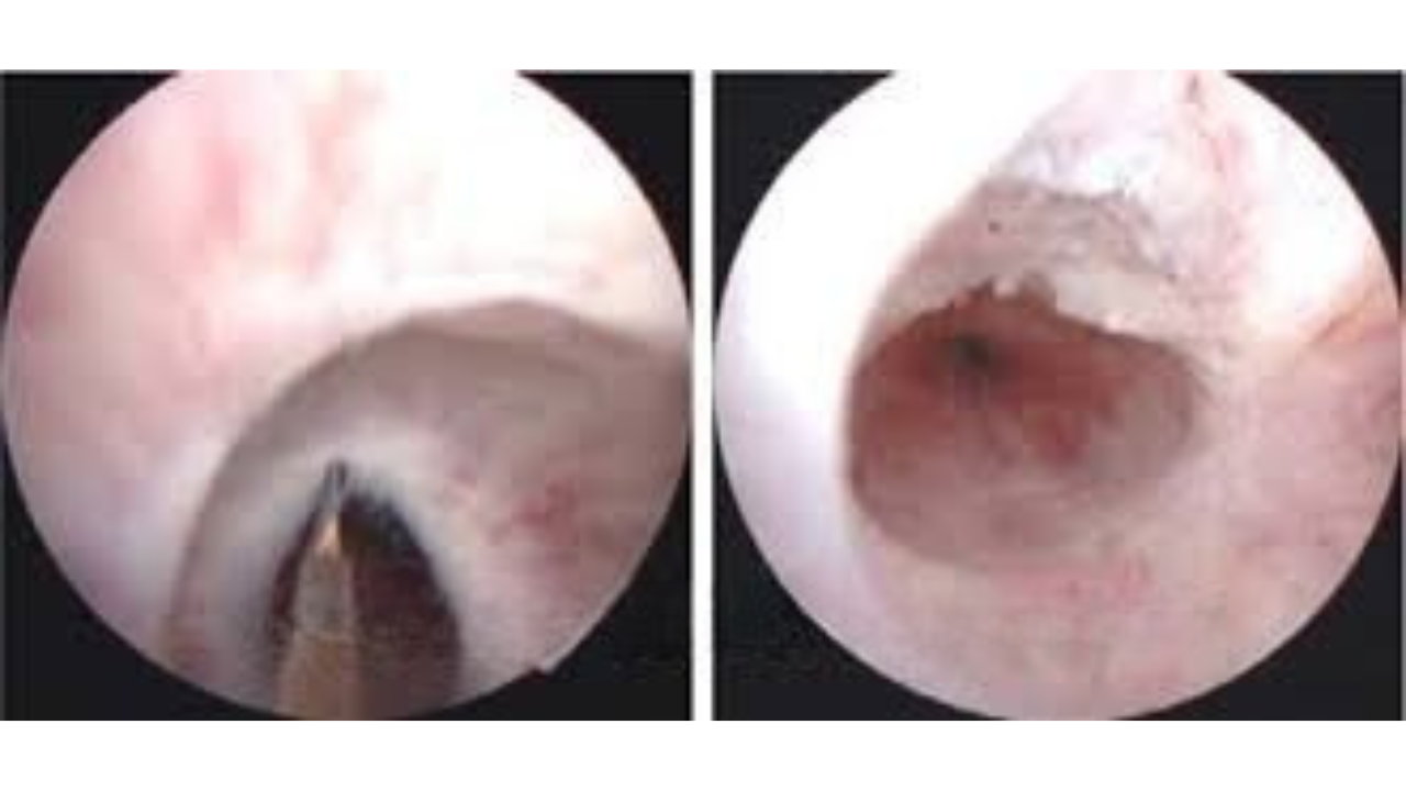 Endoscopic views of urethral stricture before and after surgical procedure